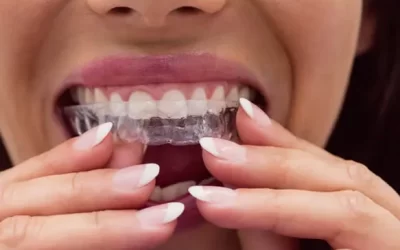 Invisalign Grand Prairie: Clear Aligner Therapy for Discreet Orthodontic Correction